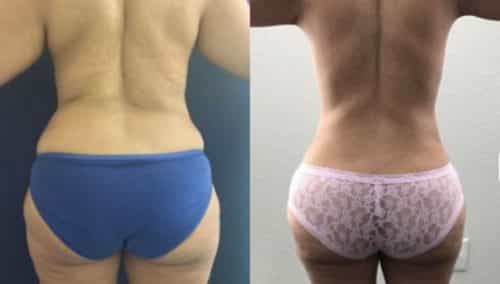 brazilian butt lift colombia 244-1-min