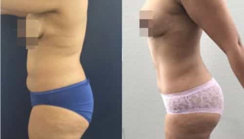 brazilian butt lift colombia 244-2-min