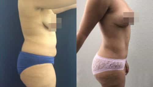 brazilian butt lift colombia 244-3-min