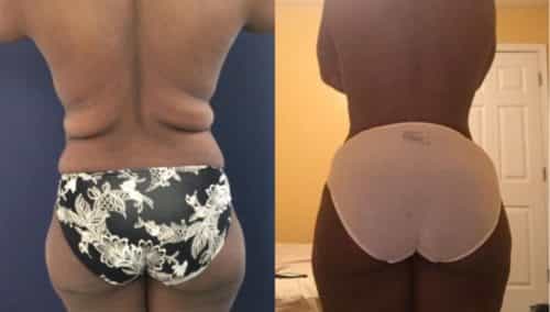 brazilian butt lift colombia 245-1-min