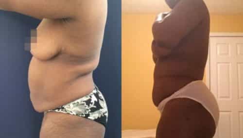 brazilian butt lift colombia 245-2-min