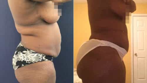 brazilian butt lift colombia 245-3-min
