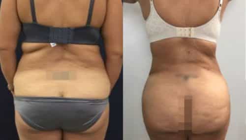 brazilian butt lift colombia 249-1-min