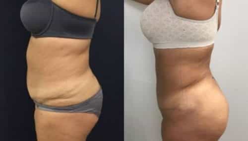 brazilian butt lift colombia 249-3-min