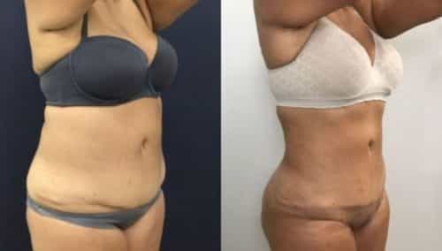 brazilian butt lift colombia 249-4-min