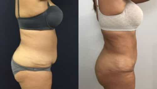 brazilian butt lift colombia 249-5-min