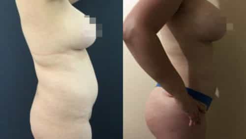 brazilian butt lift colombia 251-5-min