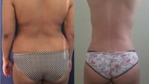 brazilian butt lift colombia 257-1-min
