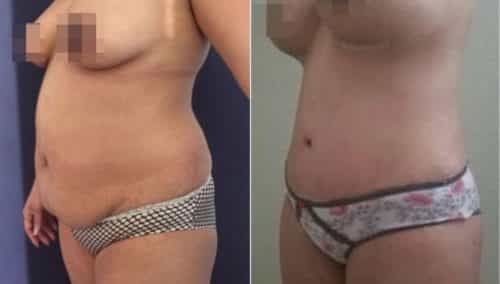 brazilian butt lift colombia 257-2-min
