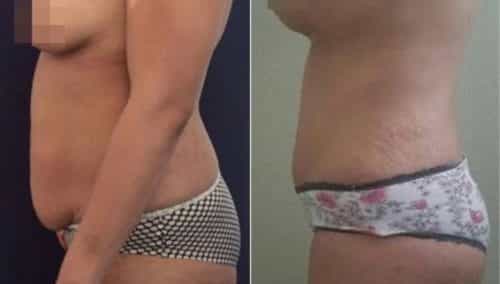 brazilian butt lift colombia 257-3-min