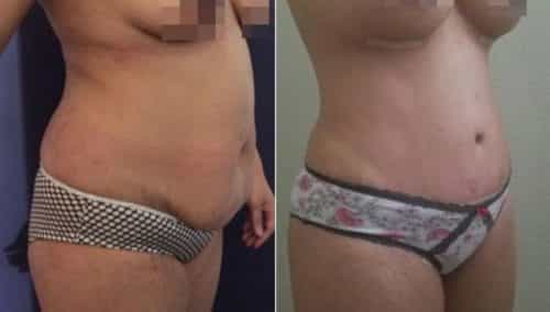 brazilian butt lift colombia 257-4-min