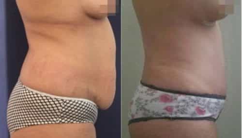 brazilian butt lift colombia 257-5-min