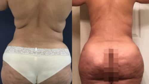 brazilian butt lift colombia 265-1-min