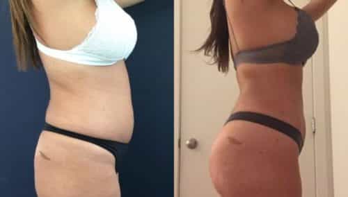 brazilian butt lift colombia 272-2-min