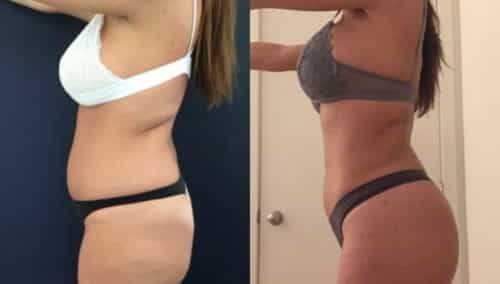 brazilian butt lift colombia 272-4-min