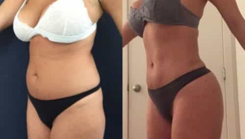 brazilian butt lift colombia 272-5-min