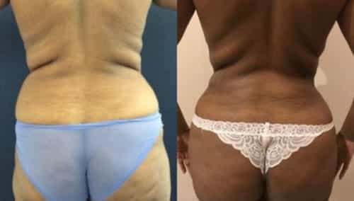 brazilian butt lift colombia 279-1-min