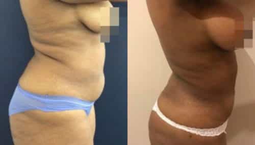 brazilian butt lift colombia 279-2-min