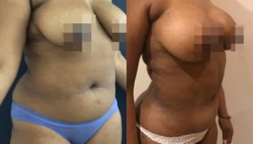 brazilian butt lift colombia 279-3-min