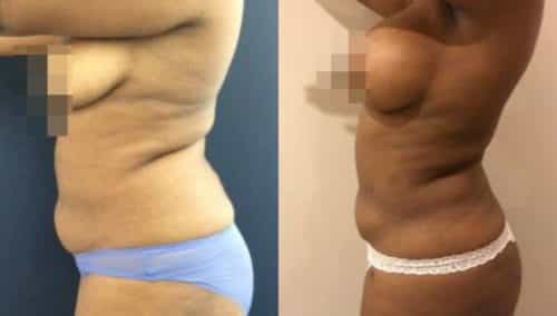 brazilian butt lift colombia 279-4-min