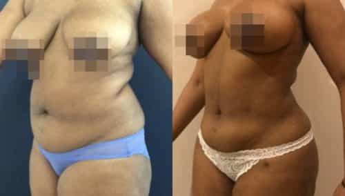 brazilian butt lift colombia 279-5-min