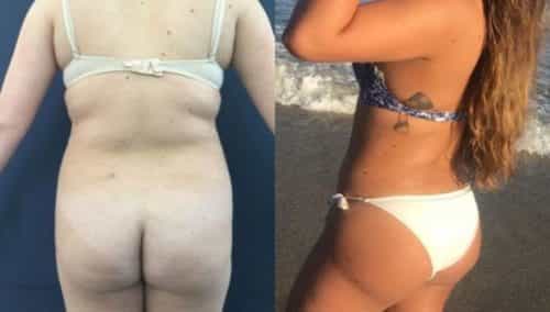 brazilian butt lift colombia 280-1-min