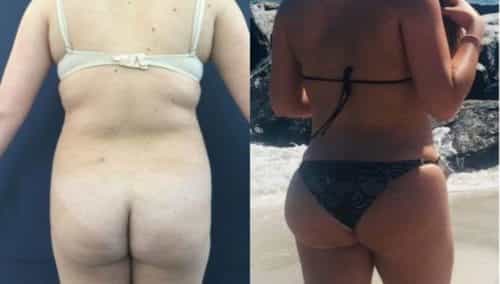 brazilian butt lift colombia 280-2-min