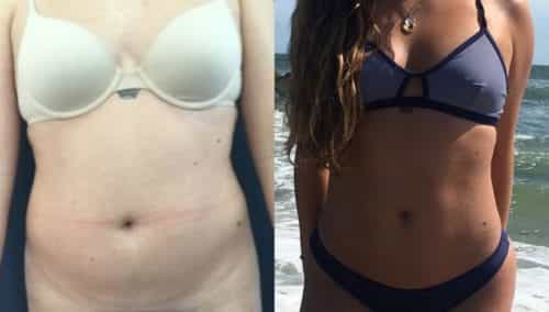 brazilian butt lift colombia 280-3-min