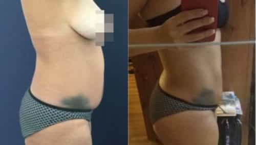 brazilian butt lift colombia 281-1-min