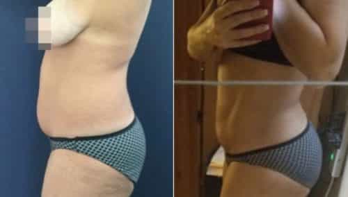 brazilian butt lift colombia 281-2-min