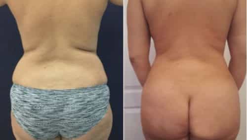 brazilian butt lift colombia 288-1-min
