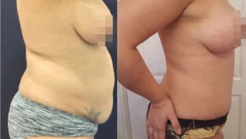 brazilian butt lift colombia 288-2-min