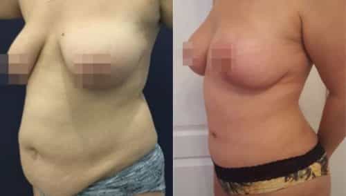 brazilian butt lift colombia 288-5-min