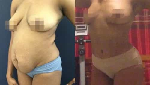 brazilian butt lift colombia 299-5-min