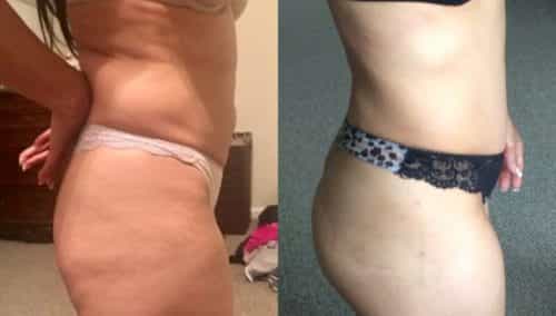 brazilian butt lift colombia 301-1-min