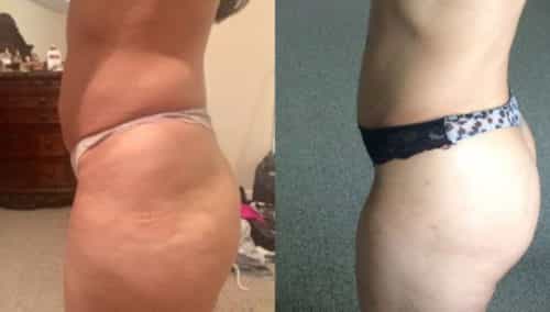 brazilian butt lift colombia 301-2-min