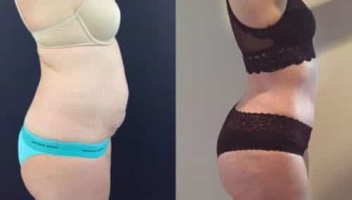 brazilian butt lift colombia 303-2-min