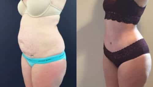 brazilian butt lift colombia 303-5-min