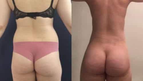 brazilian butt lift colombia 304-1-min