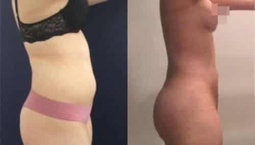 brazilian butt lift colombia 304-2-min