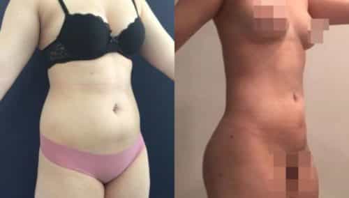 brazilian butt lift colombia 304-3-min