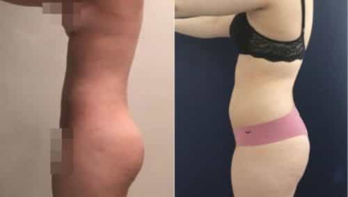 brazilian butt lift colombia 304-4-min