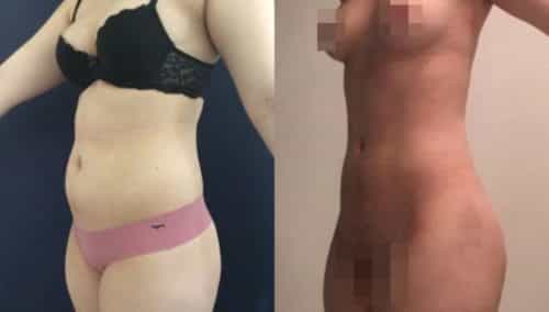 brazilian butt lift colombia 304-5-min