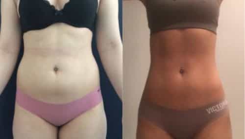 brazilian butt lift colombia 304-6-min