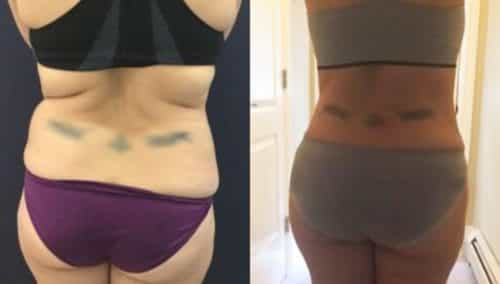 brazilian butt lift colombia 310-1-min