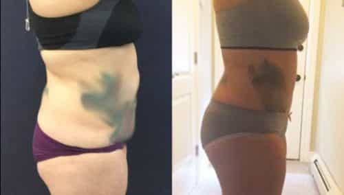 brazilian butt lift colombia 310-2-min