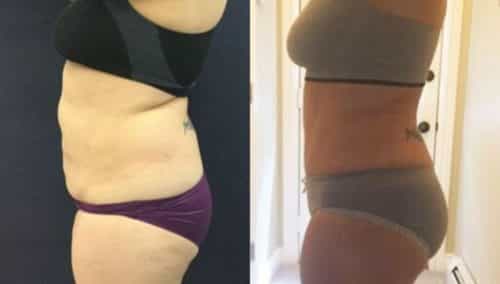 brazilian butt lift colombia 310-4-min