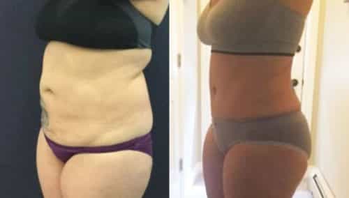 brazilian butt lift colombia 310-5-min
