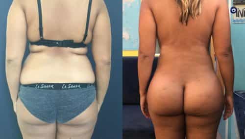 brazilian butt lift colombia 324-1-min