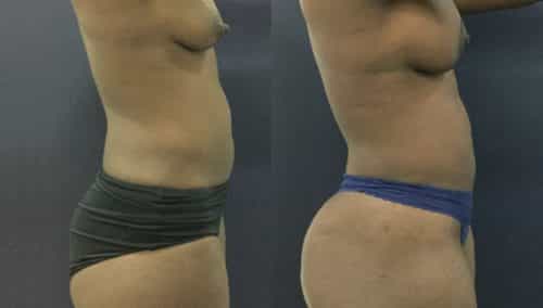 brazilian butt lift colombia 343-2-min